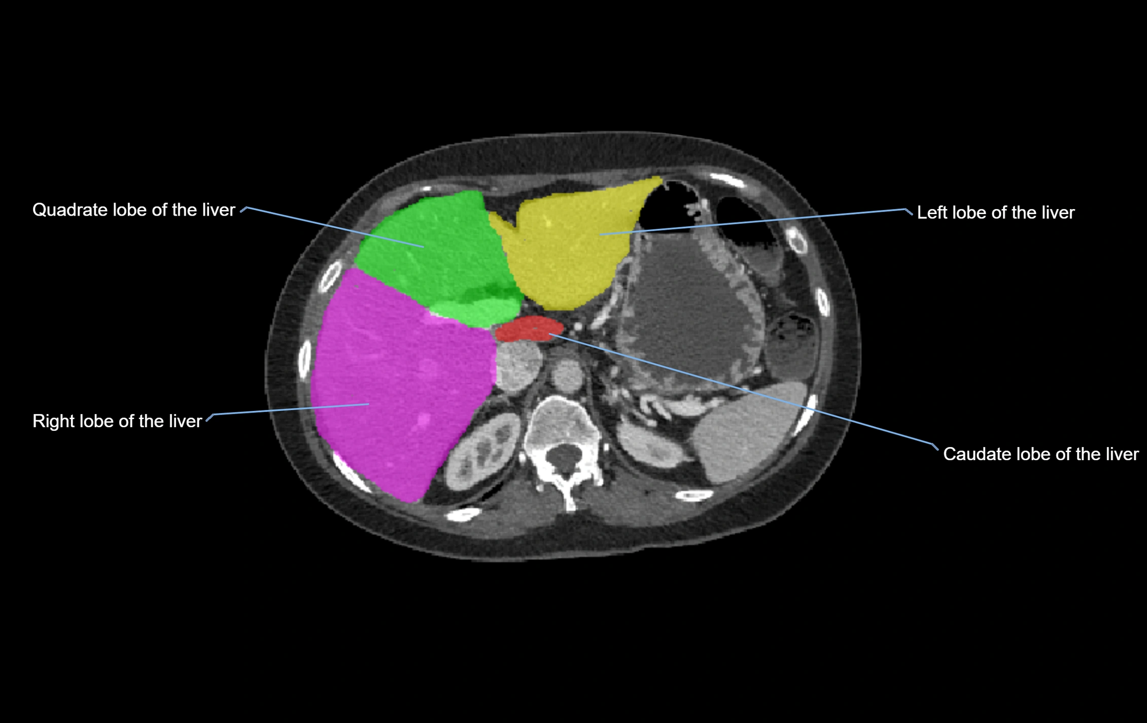 CT lliver lobes axial cross sectional anatomy labelled image -00048.webp